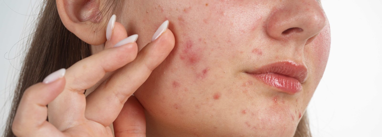 Acne