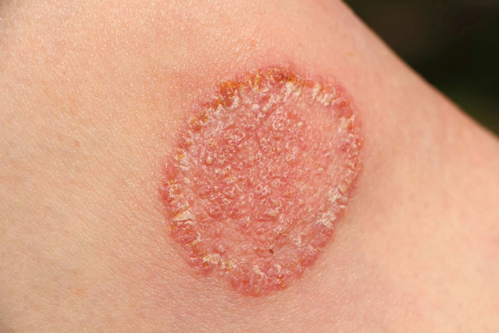 Fungal Infection