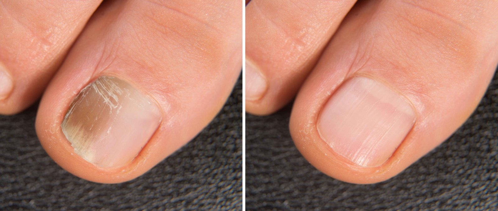 Nail Disorder