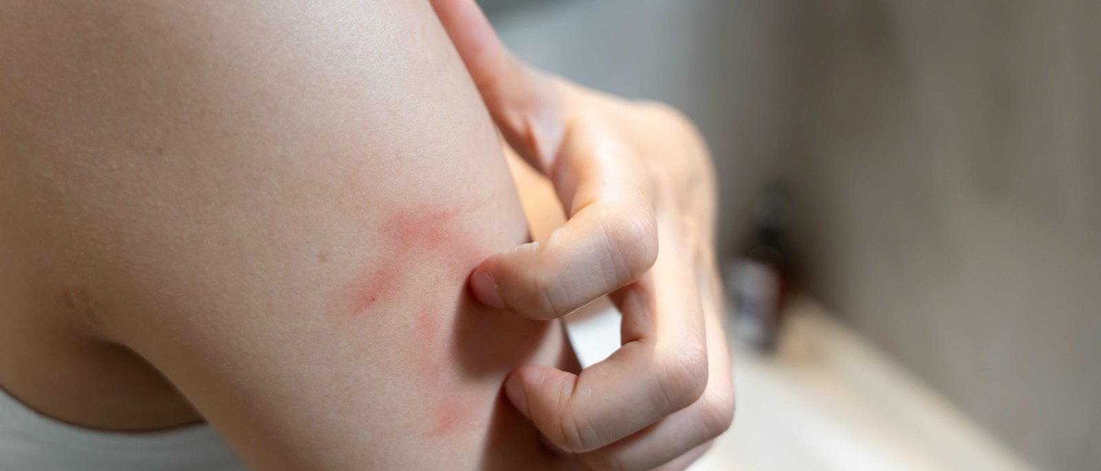 Urticaria