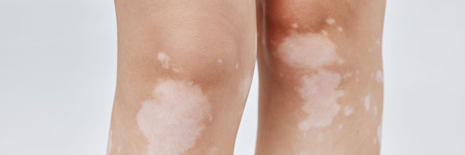 Vitiligo