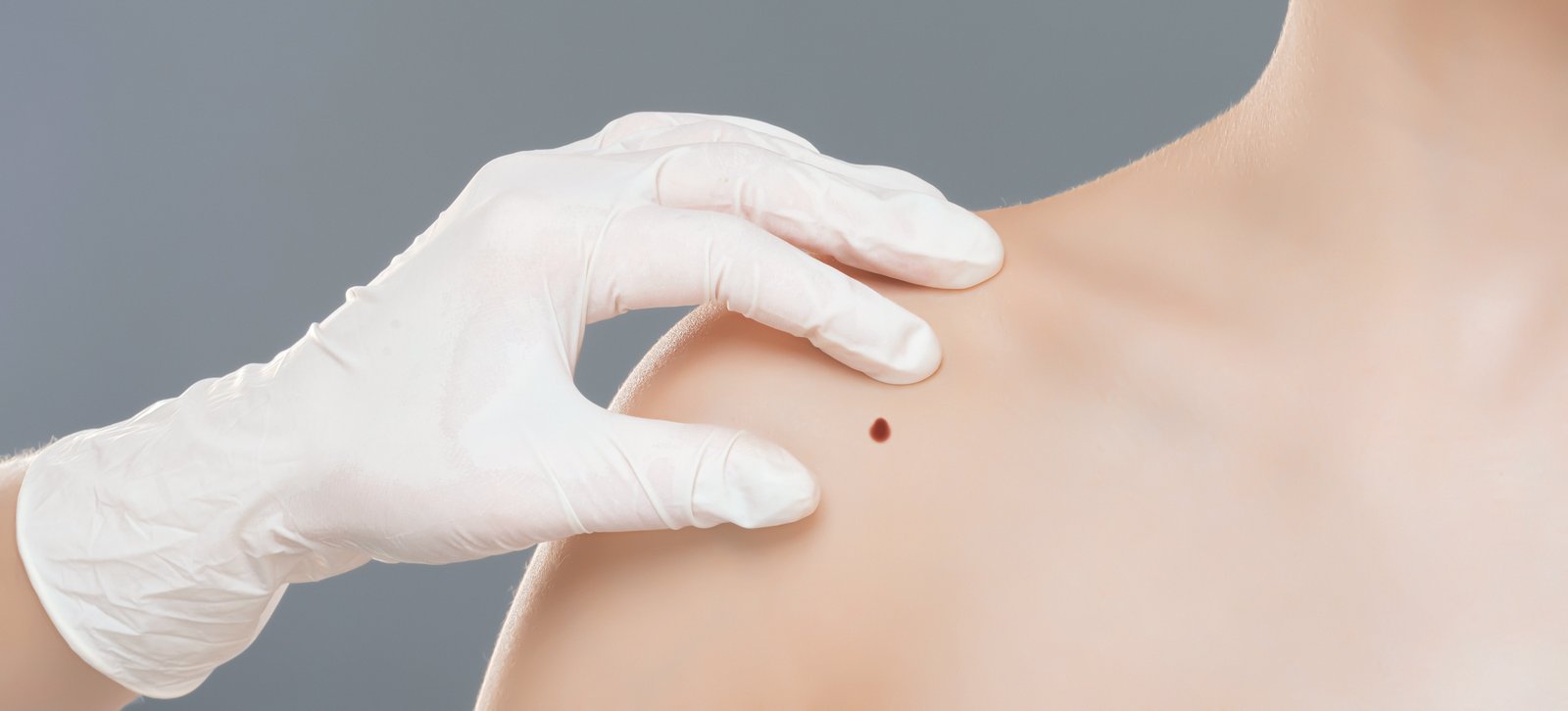 Warts & Others